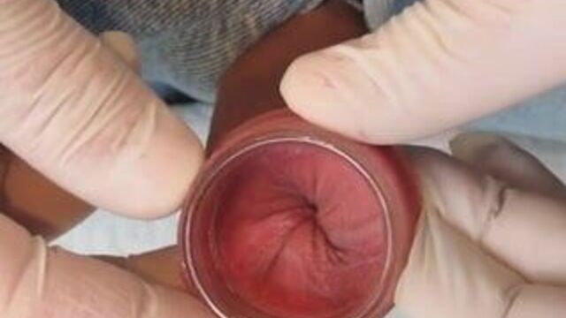 Стеклянный тоннель в крайней плоти.